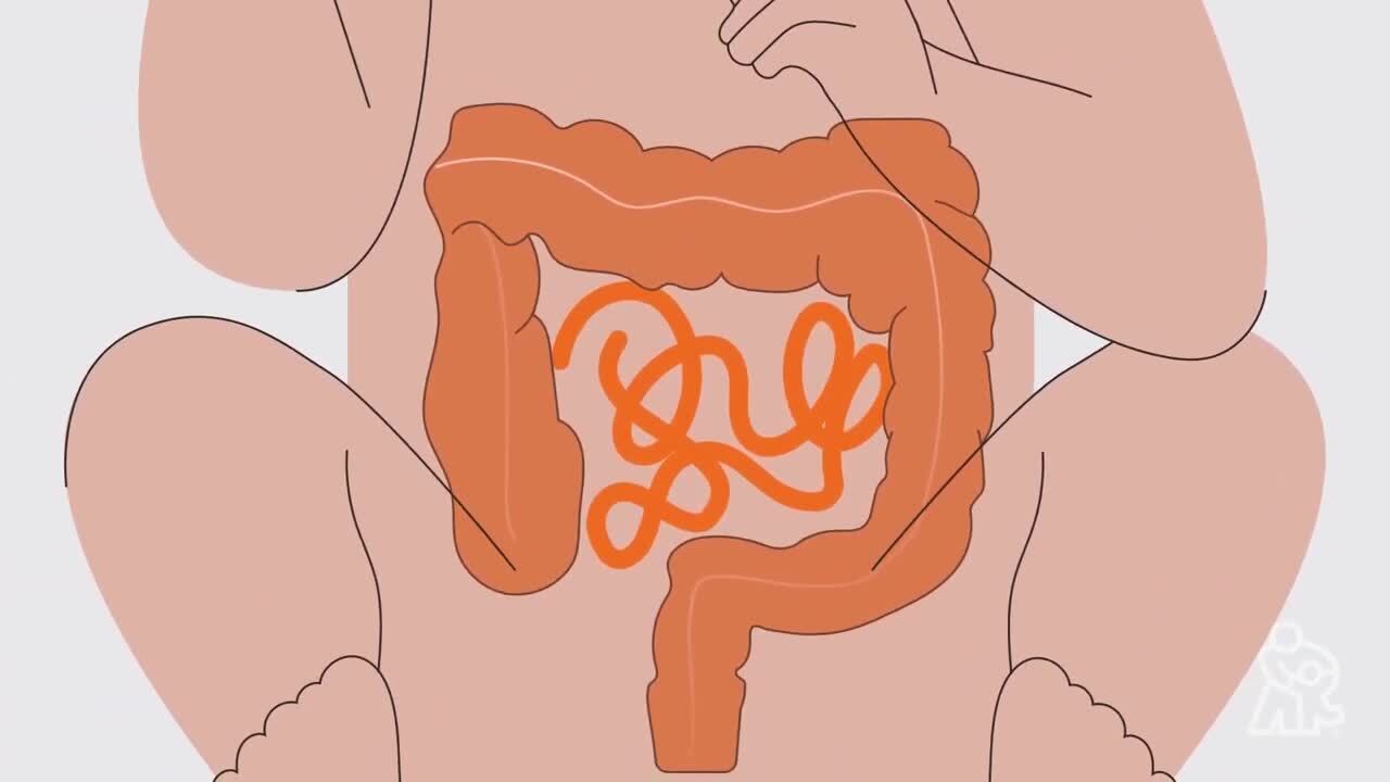 Diagnosing and Treating of Cloacal Anomaly