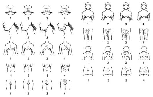 Figure I: Schematic representation of the mFG score. Nine body areas (upper lip, chin, chest, arm, upper abdomen, lower abdomen, upper back, lower back and thighs) are scored from 1 (minimal terminal hairs present) to 4 (equivalent to a hairy man). If no terminal hairs are observed in the body area being examined the score is zero (left blank). Clinically, terminal hairs can be distinguished from vellus hairs primarily by their length (i.e. >0.5 cm) and the fact that they are usually pigmented. Reproduced with permission from R. Azziz (Yildiz et al., 2010). Copyright Oxford University Press, 2010.