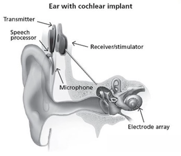Illustration showing the components of a cochlear implant, including the speech processor, microphone, transmitter, receiver/stimulator and electrode array within the ear.