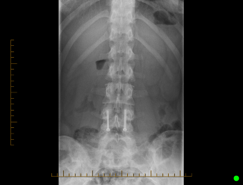 Front-view X-ray of the lumbar spine and pelvis showing the lower vertebrae and metallic surgical hardware in the lower back