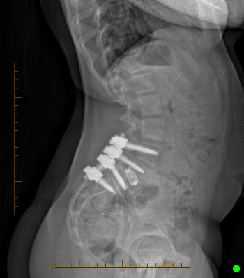 Side-view X-ray of the lumbar spine displaying surgical hardware stabilizing the lower back.