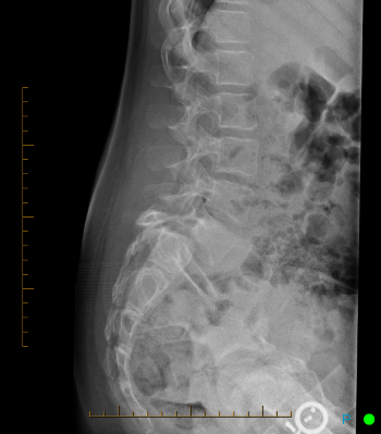 Side-view X-ray of the lumbar spine and pelvis displaying the lower vertebrae 
