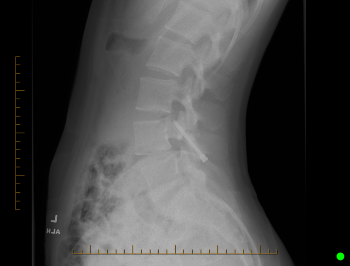 Side-view X-ray of the lumbar spine displaying the lower vertebrae, pelvis and a metallic surgical implant