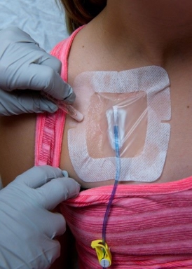 image of what a port used to administer medicine