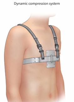 Illustration of a brace with two straps over the shoulder and one going horizontally under the arms