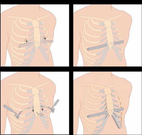Four-step diagram demonstrating surgical correction of pectus excavatum through reshaping of the chest wall and placement of a temporary support bar beneath the sternum