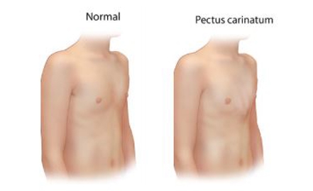 Illustration of a normal chest and a chest with pectus carinatum, demonstrating the forward projection of the chest wall caused by the condition