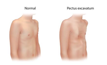 Illustration comparing a normal chest wall with pectus excavatum, showing the inward depression of the breastbone characteristic of pectus excavatum