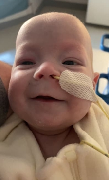 Close-up of an infant with a nasal feeding tube secured to the cheek.