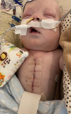 Infant resting in a hospital bed with medical tubing and monitoring equipment, with a healing surgical incision on the chest.