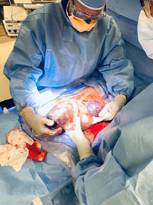 Surgeon performing a C-section procedure with baby being born in amniotic sac.