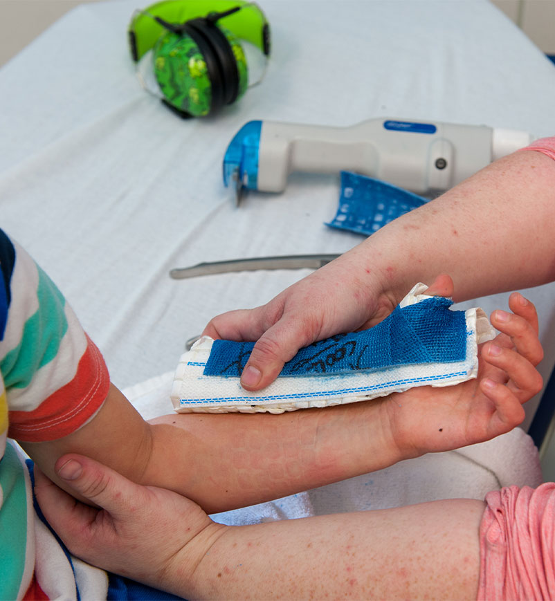 image of the last step of getting a cast remove where the cast is off and the arm is visible 